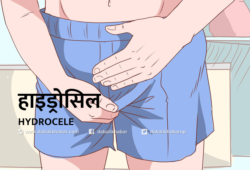 hydrocele nuwakot nepal