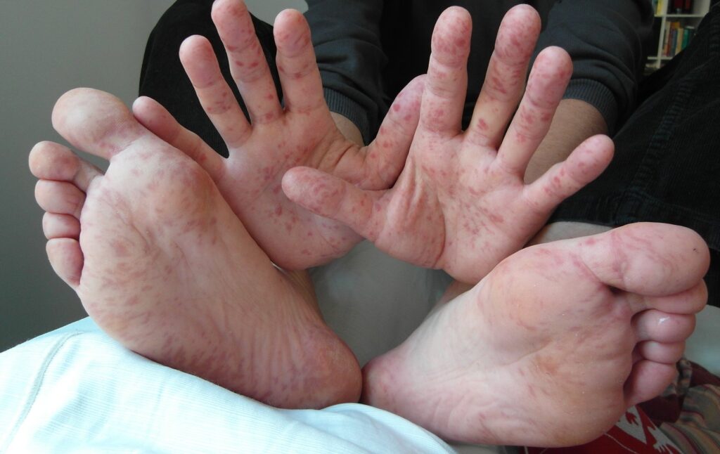 coxsackievirus