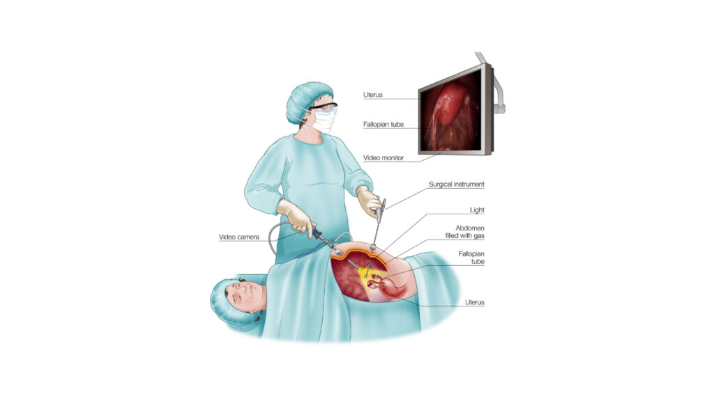 Laparoscopy trishuli hospital